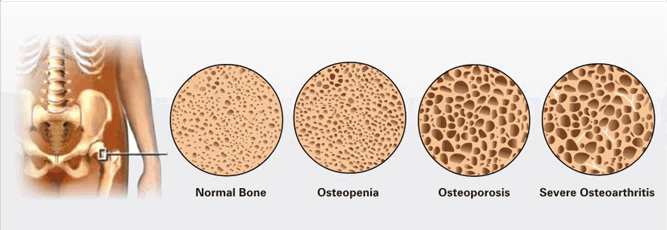 Strong And Stable Osteopenia Osteoporosis And Exercise